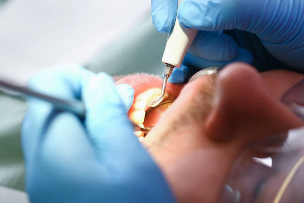 Best Emergency Treatment for Dental Infections or Abscesses in Malvern, OH